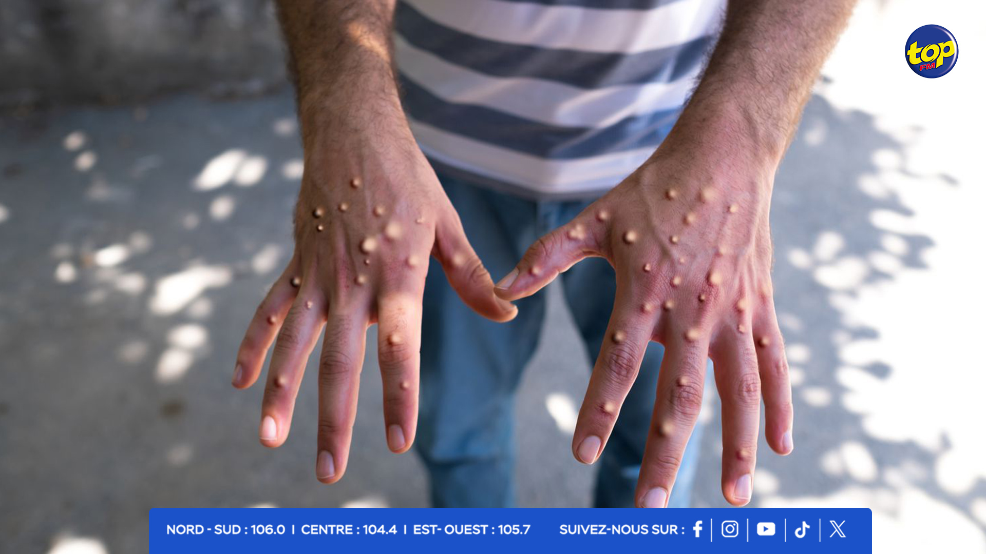 MPOX MPOX