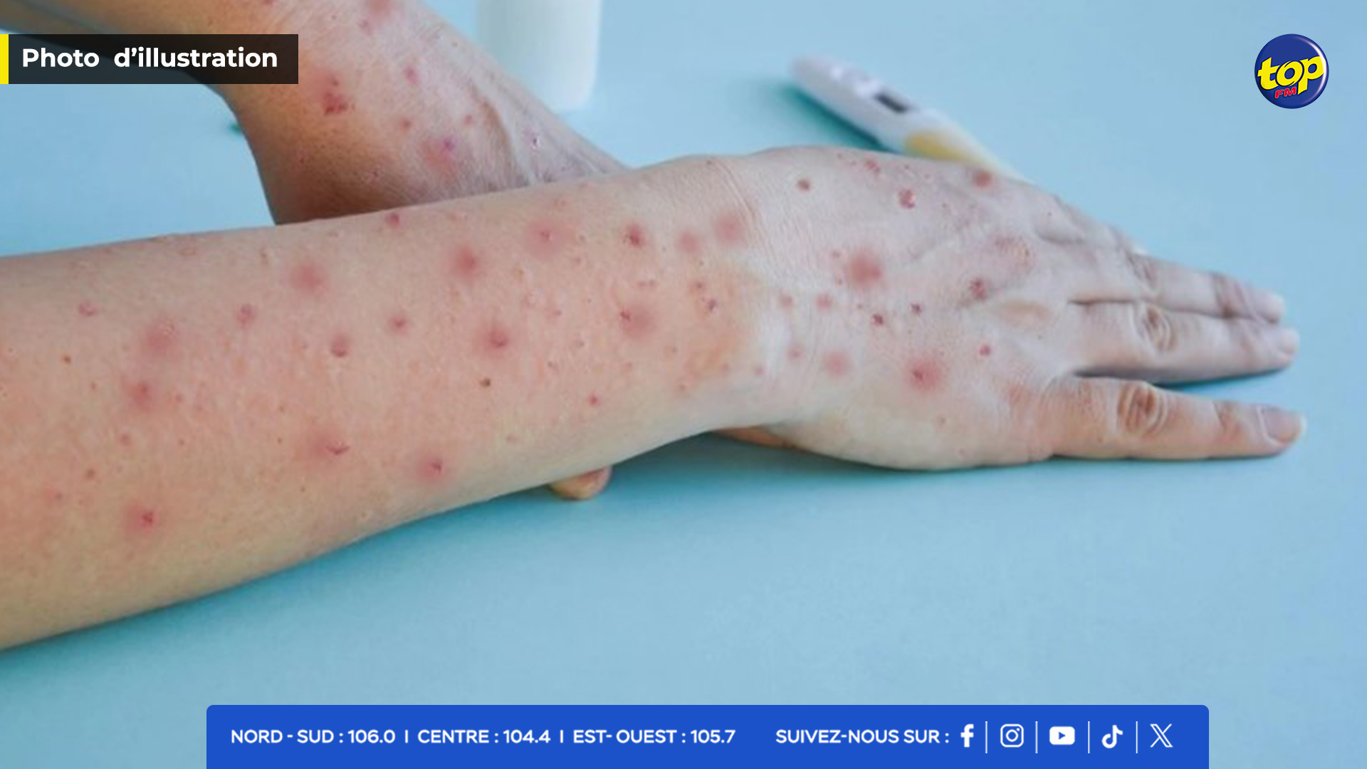 MPOX MPOX